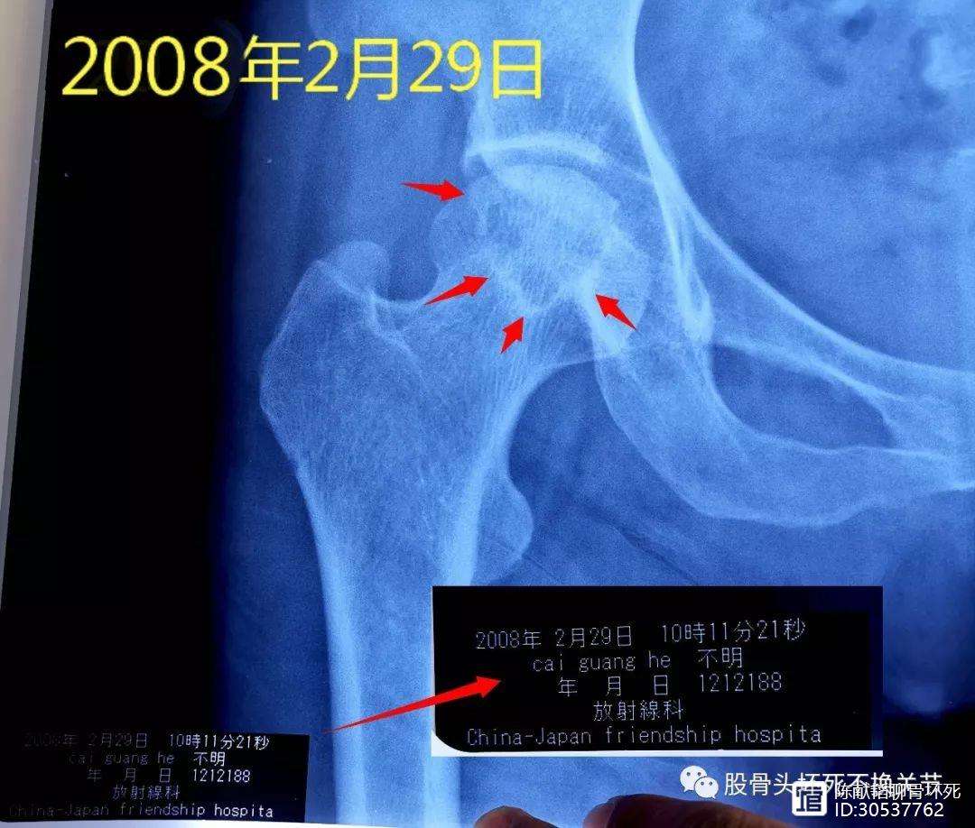 三明人工骨头医保报销多少(人工骨头医保报销多少比例)